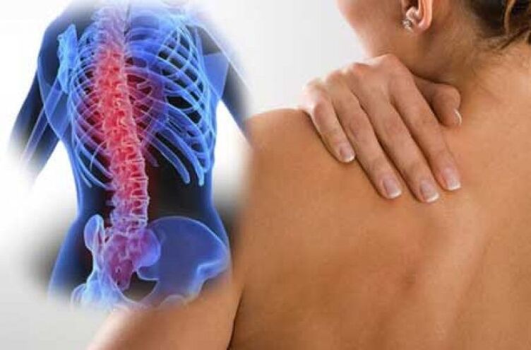 Mat Osteochondrose kann Schmerz op wäit ewech vum Kierper ausstrahlen