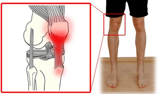 Tendinitis ass eng Entzündung vum Sehngewebe, déi Schmerz am Kniegeleent verursaacht. 