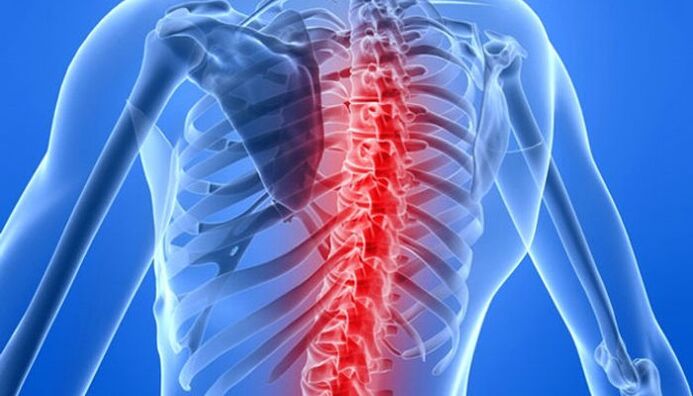 Spinal Pathologien sinn déi heefegst Ursaache vu Réckschmerzen am Schëllerbladgebitt