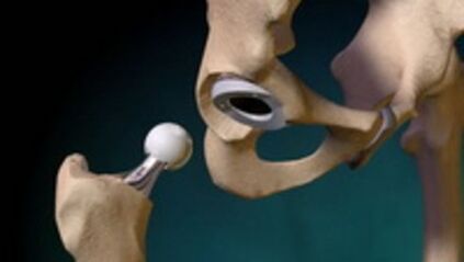 Problem fir den Hip Joint