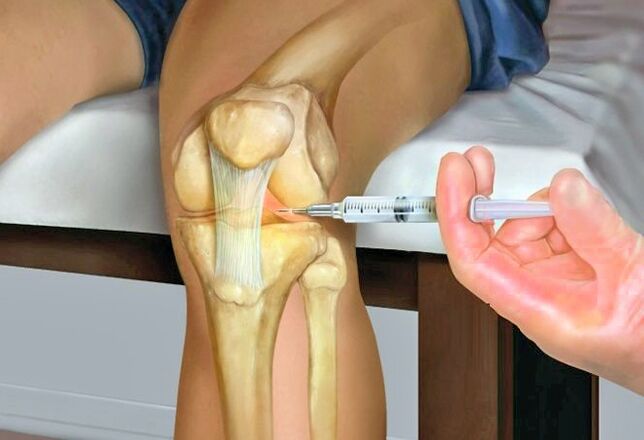 Behandlung vun Arthrosis vum Knéi Gelenk