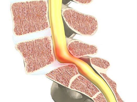Blutt-Motor Segment fir Osteochonds