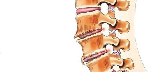 Spondyloses - Zerstéierung vun intervertebrale Gelenker