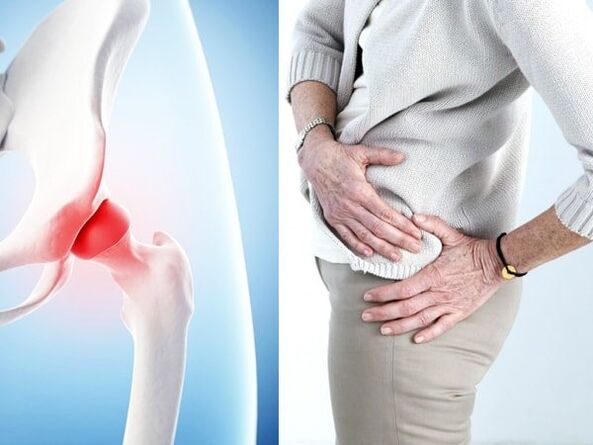 Symptomer vun Arthrosis vum Hip Joint
