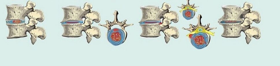 verschidde Etappe vun thoracic Osteochondrosis