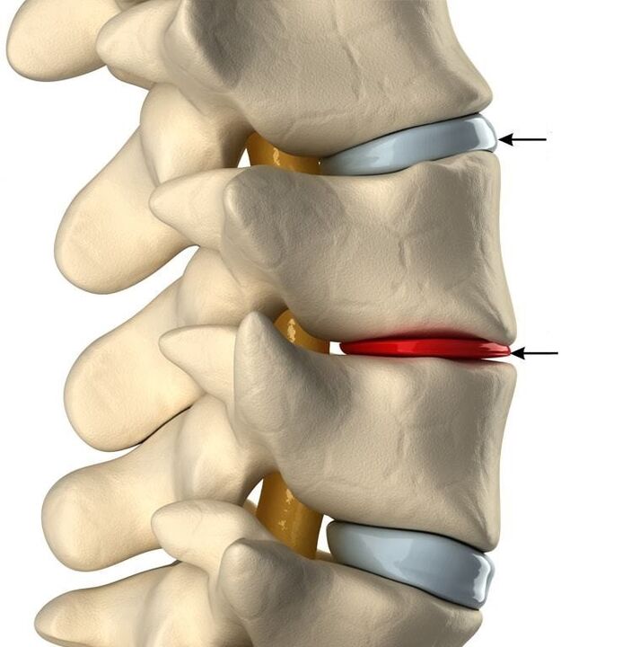 Ënnerscheed tëscht engem gesonde Disc an engem Disk mat OsteOchondrosis