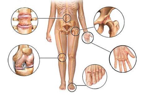Arthrosis beaflosst verschidde Gelenker
