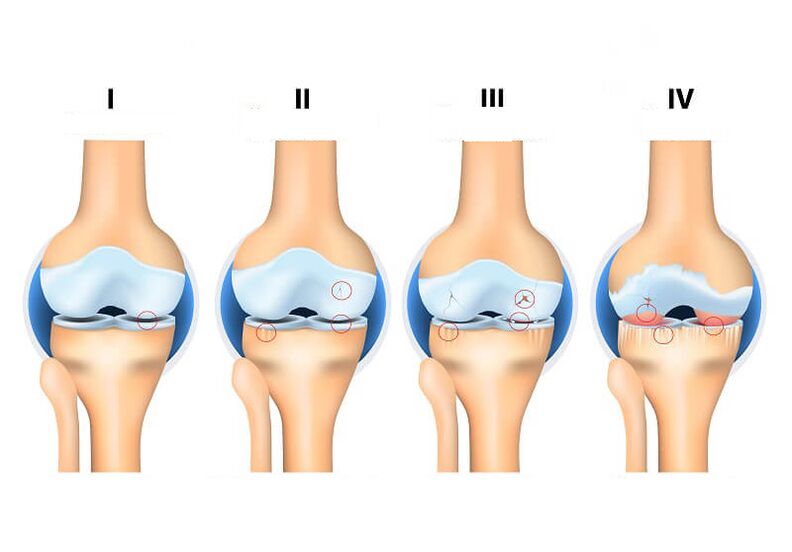 Etappe vun gemeinsame Arthrosis