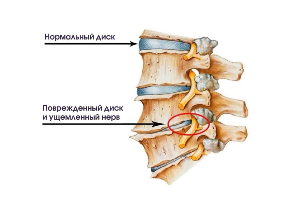 Symptomer vun cervical osteochondrosis