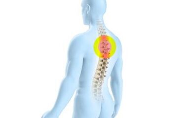 Osteochondrose vun der thoracic Wirbelsäule
