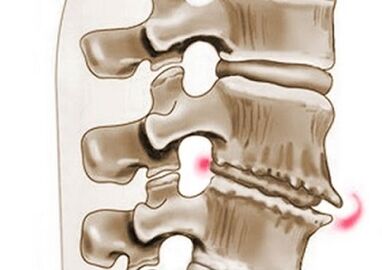 Schied un de Wirbelen an der thoracescher Osteochondrose