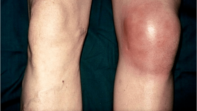 Arthrosis an Arthritis