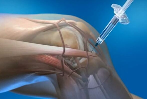 intra-artikulär Injektiounen fir Arthrosis vum Kniegelenk
